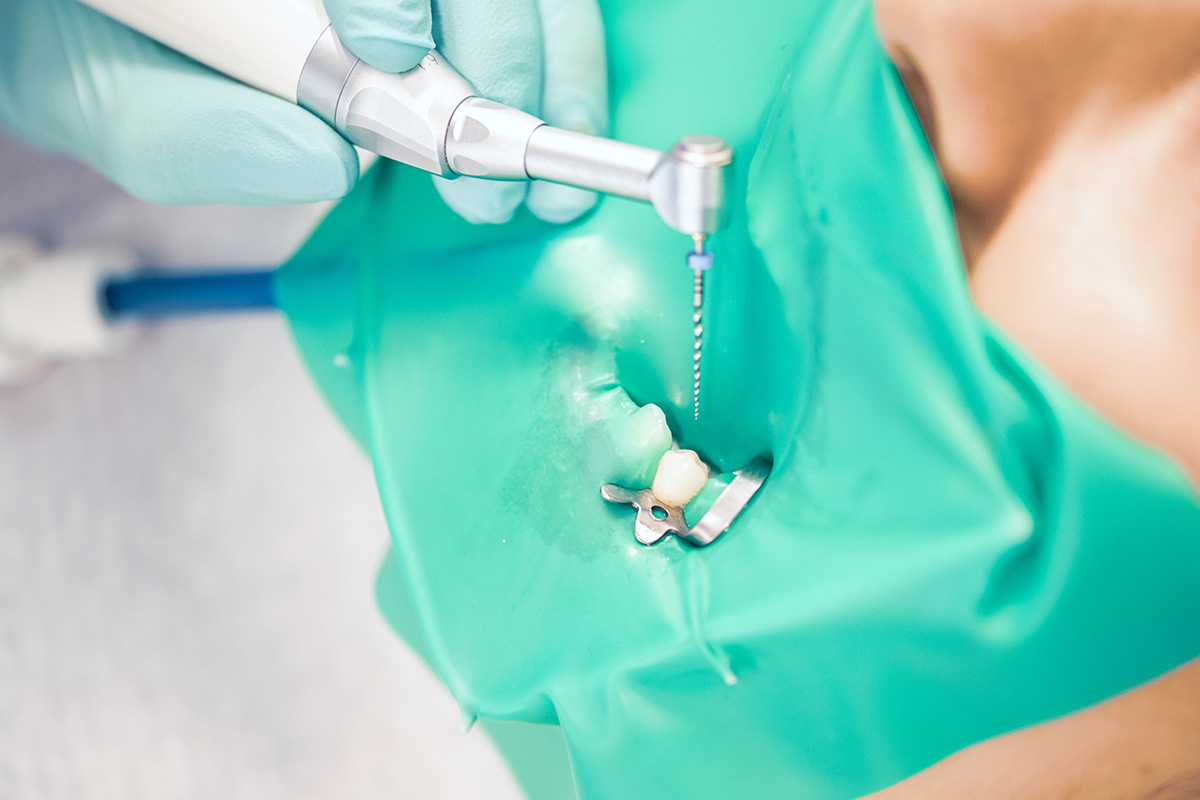 ラバーダム防湿